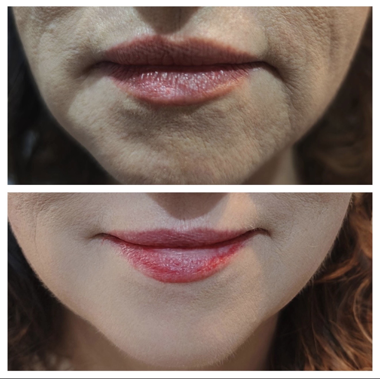 Efekty zabiegu kosmetologicznego